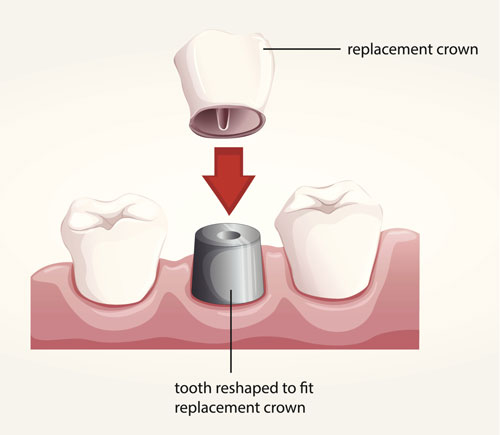 Diagram of dental crowns with varying placement at Uptown Family Dental in Portland, OR