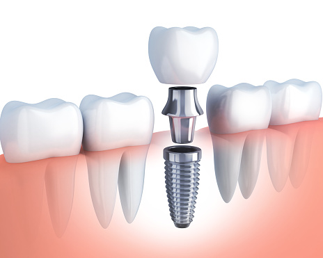 Single tooth implant in a row of teeth at Uptown Family Dental in Portland, OR