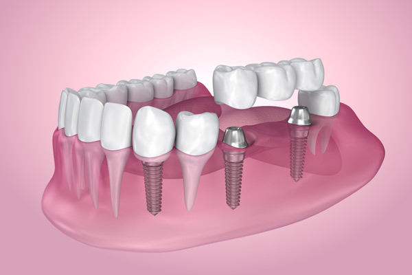 3D rendering of mouth with multiple dental implants at Uptown Family Dental in Portland, OR