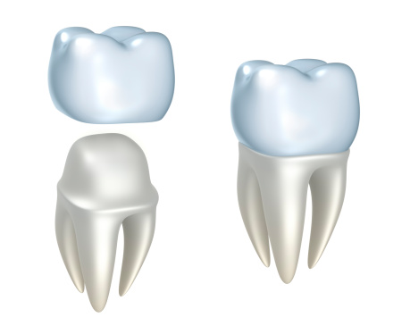 A dental crown above tooth and tooth with dental crown placed at Uptown Family Dental in Portland, OR