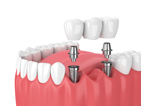 Rendering of jaw with dental bridge supported by dental implants at Uptown Family Dental in Portland, OR