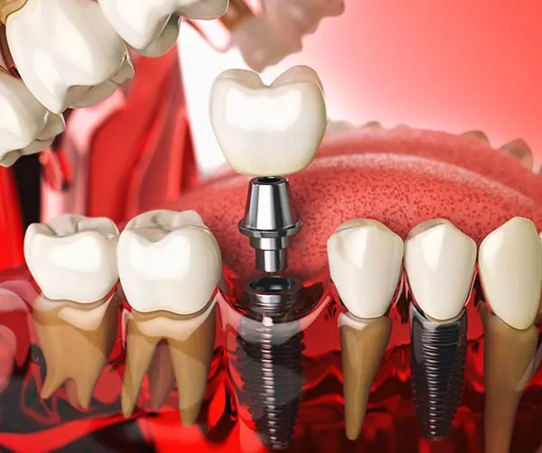 3D model showing how dental implants are placed